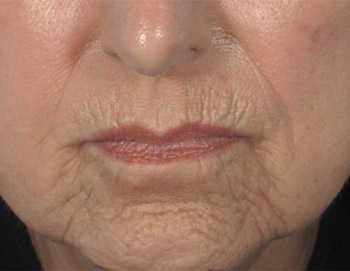 AcuPulse laser treatment for perioral rhytides, patient before treatment, epiclinic Adelaide
