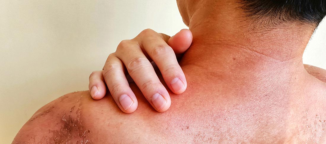 sun damage on a male patient - blog image