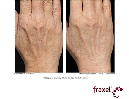 fraxel laser treatment before ad after - image 013