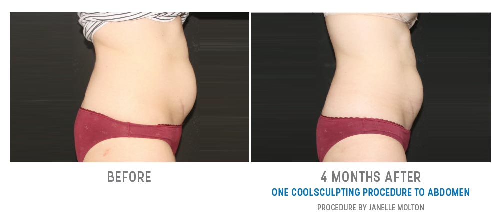 coolsculpting before and after - image 021 - side view