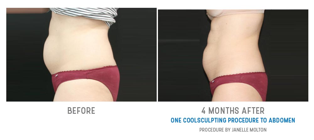 abdominal fat freezing - before and after - image 020 - side view