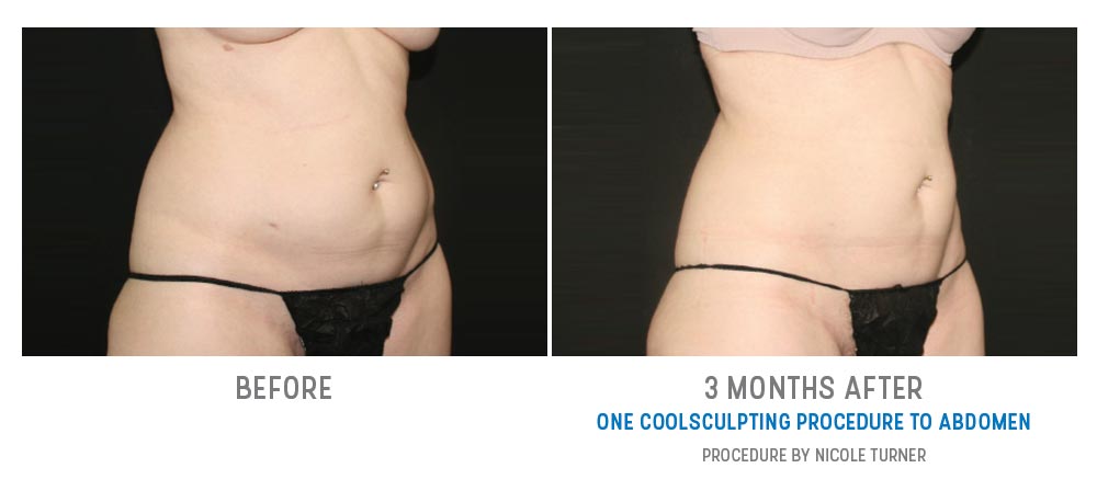 abdominal fat freezing before and after - image 017 - 45 degree view