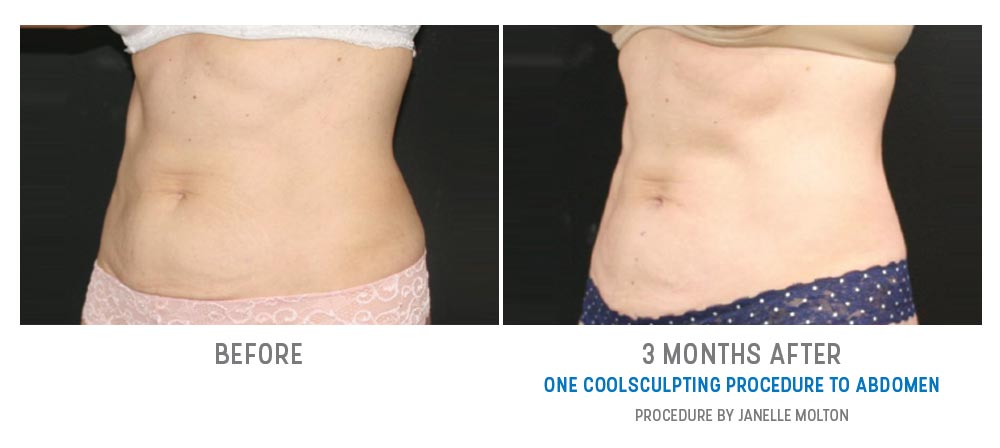 abdominal coolsculpting before and after - 45 degree view - image 014