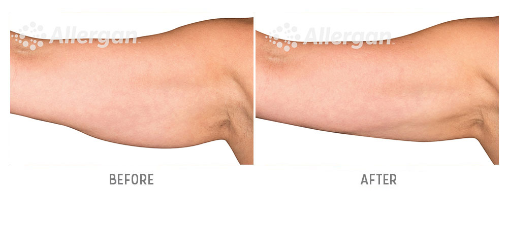 arms coolsculpting before and after - patient 001 - side view