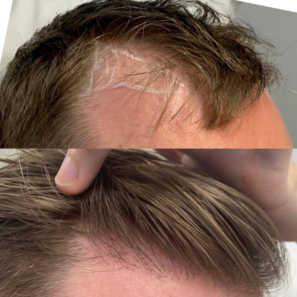 Hair Transplant epiclinic results 2